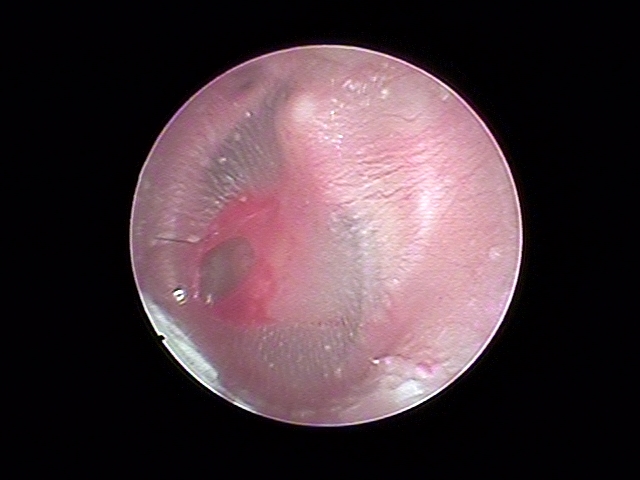 耳掃除による左外傷性鼓膜穿孔例