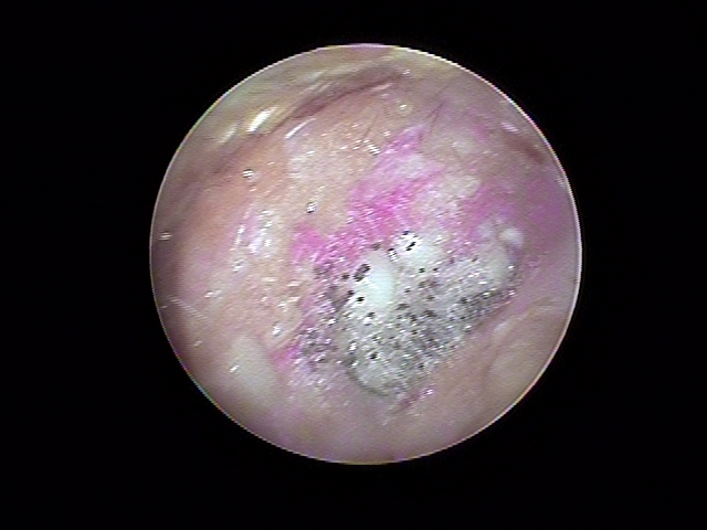外耳道真菌症（カビ）